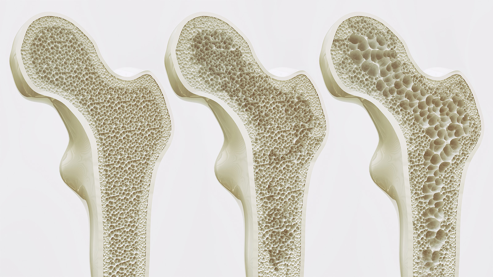 6 Tips Mencegah Osteoporosis dengan Cara Sederhana