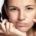 7 Tips Mencegah Jerawat Sebelum Menstruasi