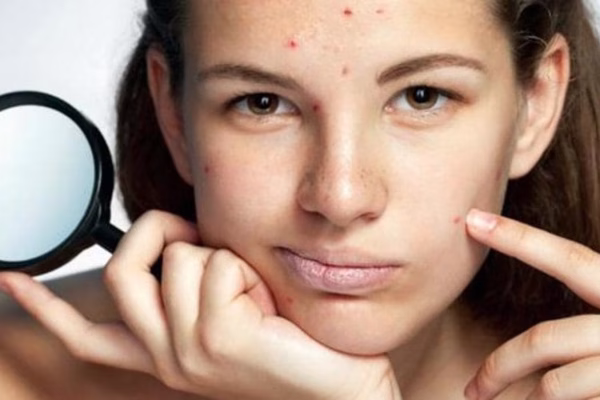 7 Tips Mencegah Jerawat Sebelum Menstruasi 7 Tips Mencegah Jerawat Sebelum Menstruasi