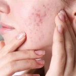 10 Tips Mengatasi Jerawat Meradang Tanpa Bikin Iritasi